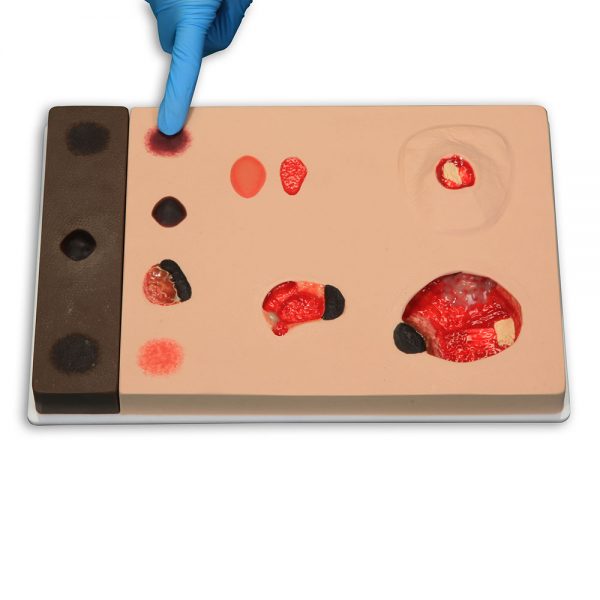 Pat Pressure Injury Staging Model